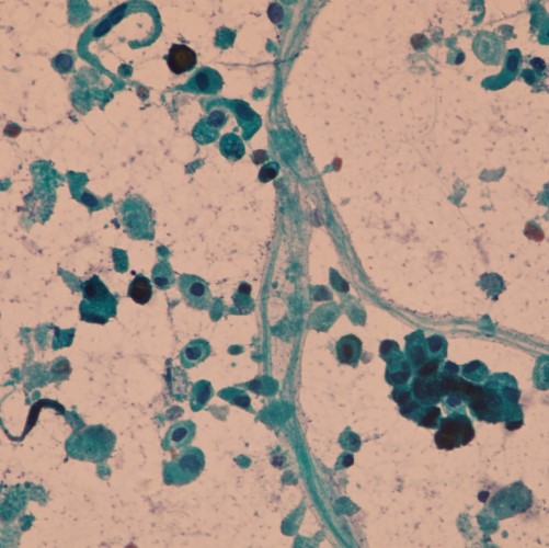Citología urinaria en fresco y coloreada: detección de patologías benignas y malignas
